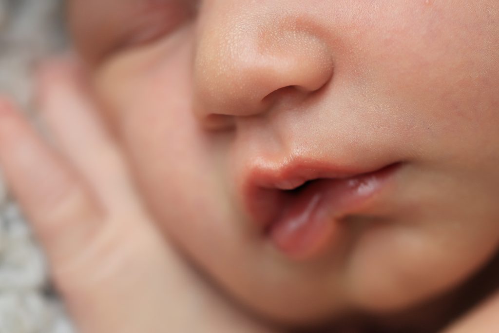 【医師監修】口唇口蓋裂の原因は遺伝？ それ以外にも原因はあるの？