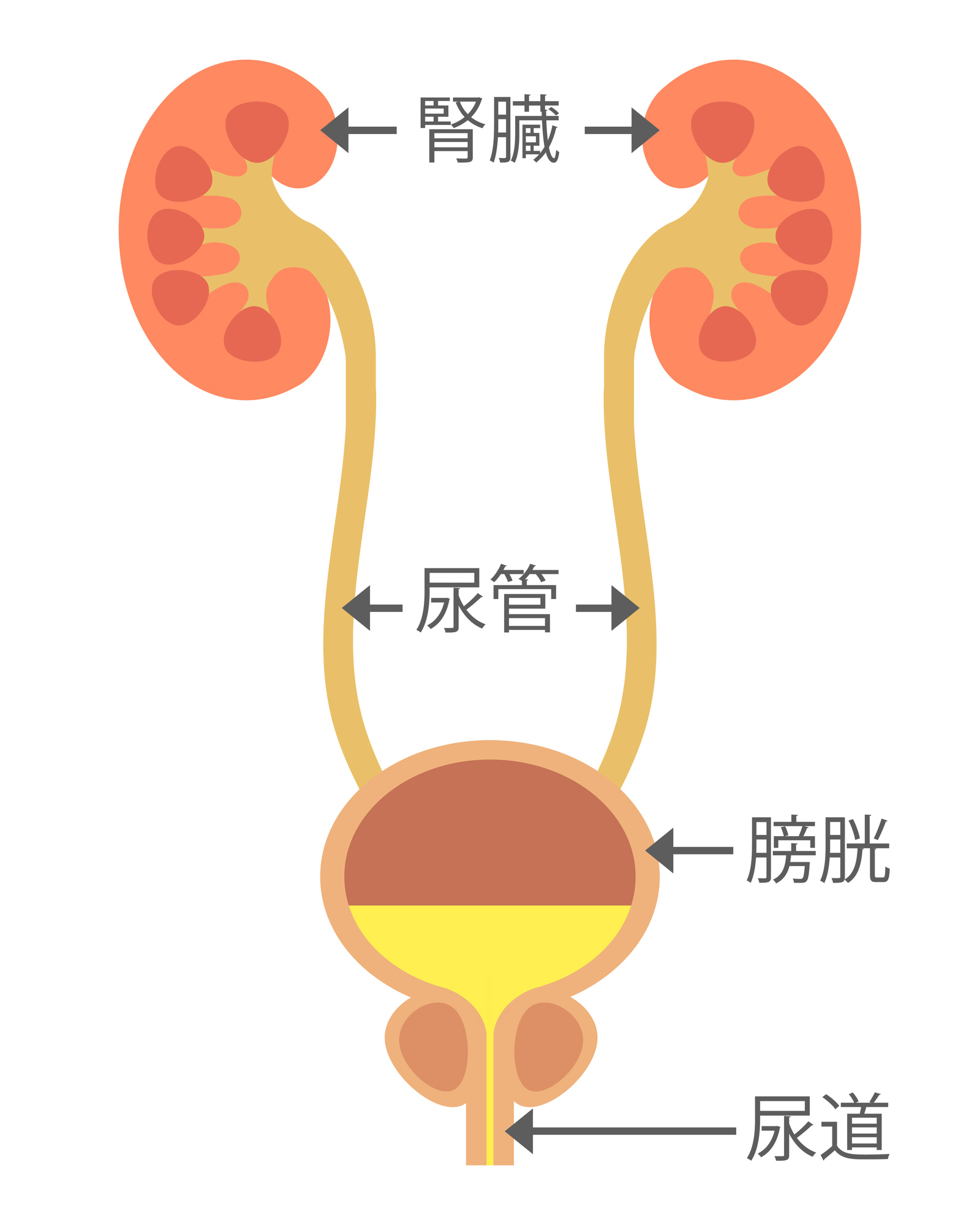 【医師監修】痛みを感じにくい尿路結石があることを知っていますか？