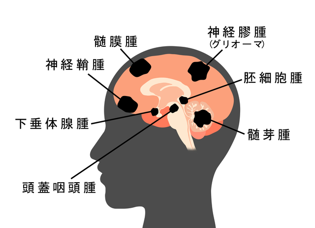 頭痛は脳腫瘍の兆候ですか?