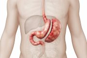 胃を切除したあとの食事とは。少量ずつ食べる理由と日常生活の注意点